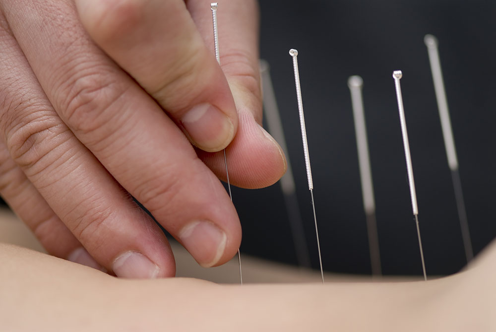 Behandling med akupunktur
